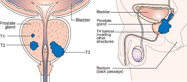 T1 to T4 of TNM staging system for prostate cancer