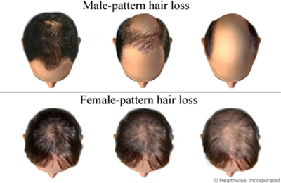 hair loss patterns in men and women