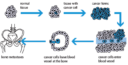 how does cancer of prostate spread into bones