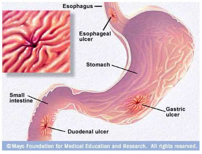 (gastric)_stomach_ulcer_credit_to_MayoClinic